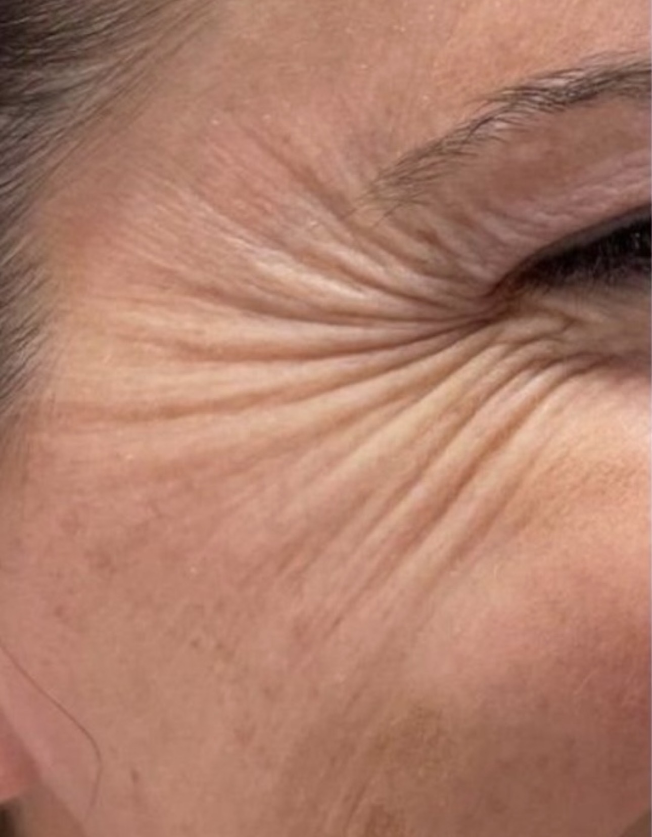 Antes del tratamiento con toxina botulínica